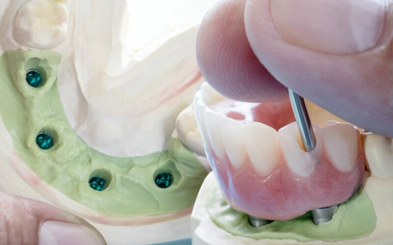 Ghid pentru protezele dentare susţinute pe implant