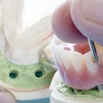 Ghid pentru protezele dentare susţinute pe implant