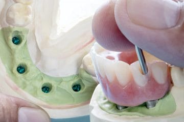 Ghid pentru protezele dentare susţinute pe implant