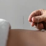 Tehnici Avansate în Acupunctură: Echilibrul Energetic și Vindecarea