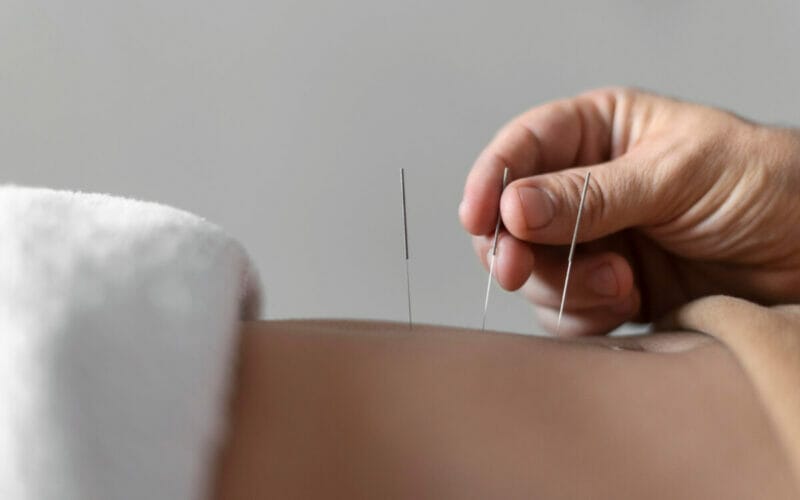 Tehnici Avansate în Acupunctură: Echilibrul Energetic și Vindecarea