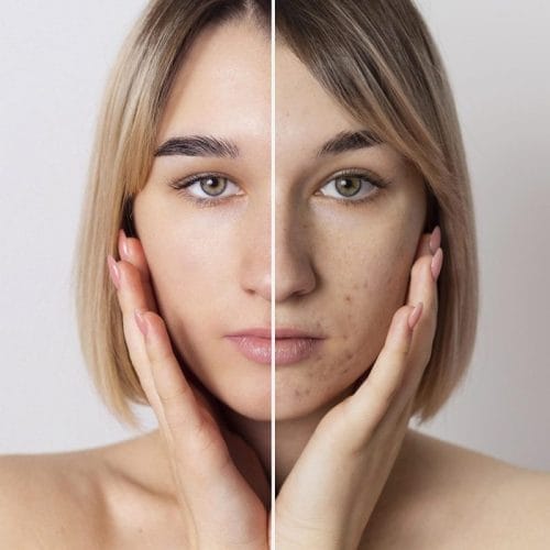 Acneea la adulți: cauze, rutina corectă, tratament și microneedling