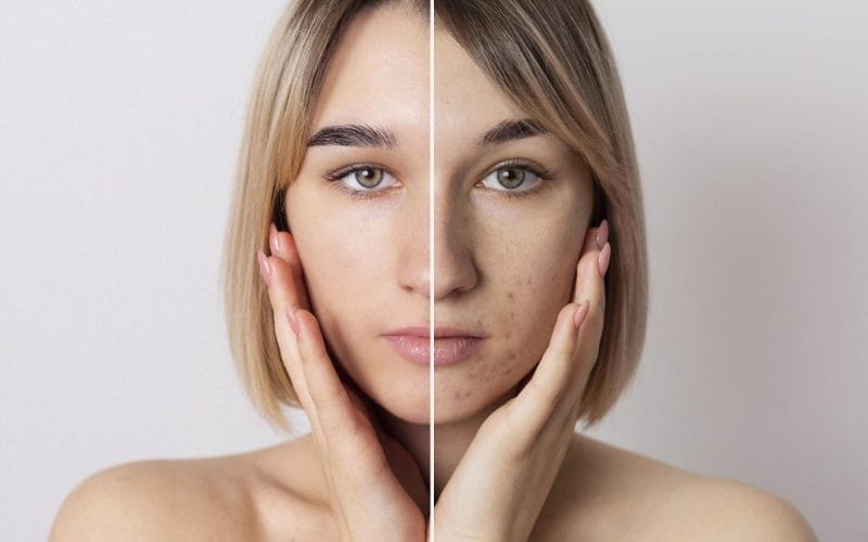 Acneea la adulți: cauze, rutina corectă, tratament și microneedling