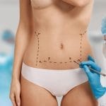 Corpul tău, regulile tale: Ghidul tău despre liposucție și abdominoplastie