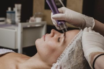 Excizia alunițelor cu laserul CO2: Cum funcționează, avantaje și ce trebuie să știi înainte de procedură